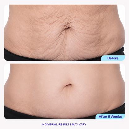 Belly Firming Cream – Plant Essence Skin Tightening Lotion