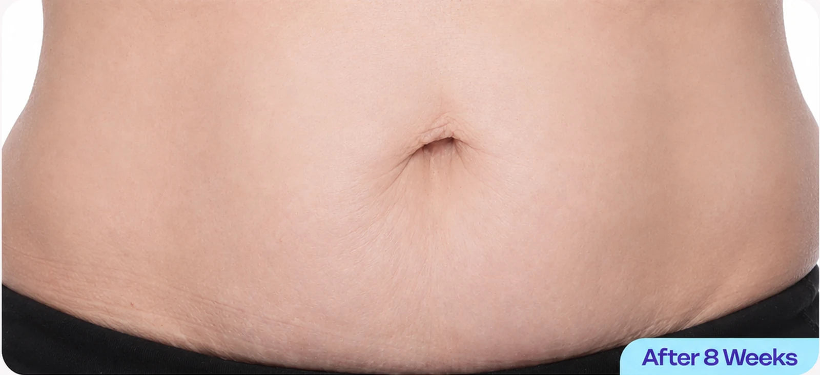 Illustrative after consistent belly skincare